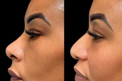 Non-Surgical Nose Job miami
