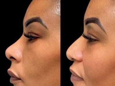 Non-Surgical Nose Job miami