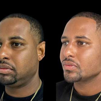 Facial Harmonization miami