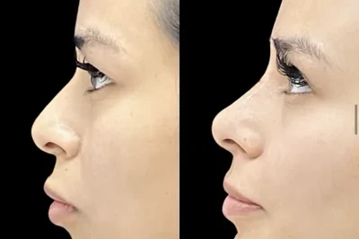 Non-Surgical Nose Job miami