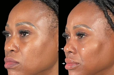 Facial Harmonization miami 02