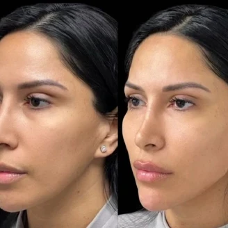 Facial Harmonization miami 04