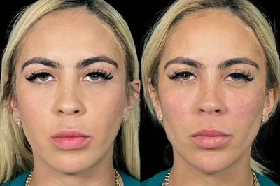 Facial Harmonization miami 05