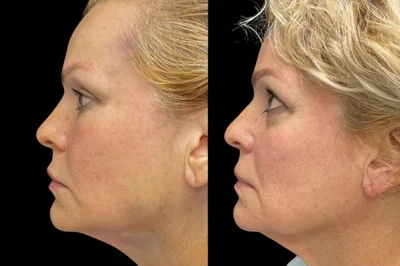 Permanent Threads miami 01