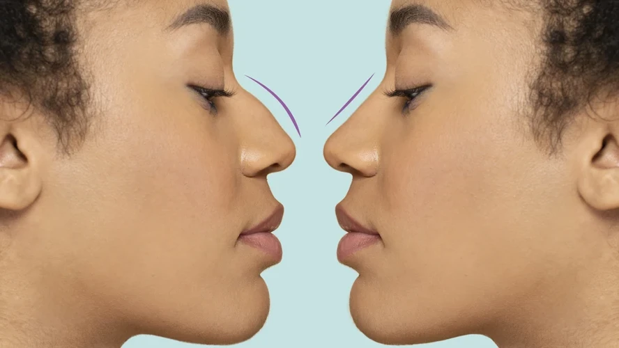 Bulbous Nose Tip Without Surgery