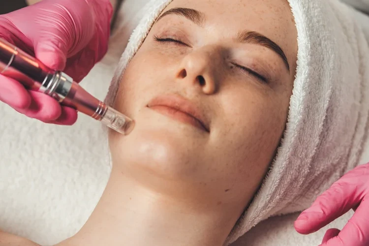 Is Microneedling Permanent Lasting Skin Benefits