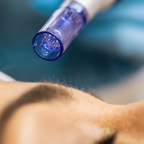 How to Treat Breakouts After Microneedling