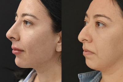 Non Surgical Nose Job Miami 03