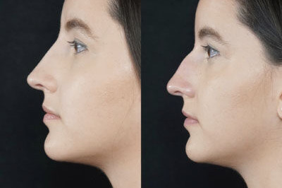 Non Surgical Nose Job Miami 08