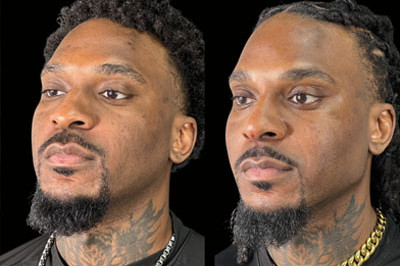 Facial Balancing miami 02