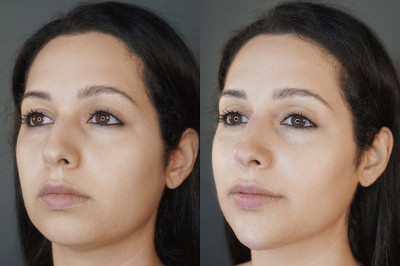 Facial Balancing miami 06