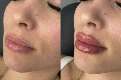 Lip Filler Miami 01