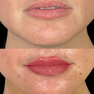 Lip Filler Miami 04