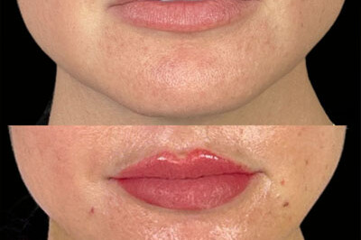 Lip Filler Miami 04