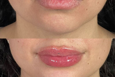 Lip Filler Miami 05