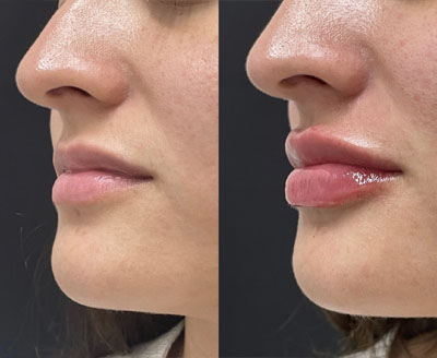 Lip Filler Miami 11