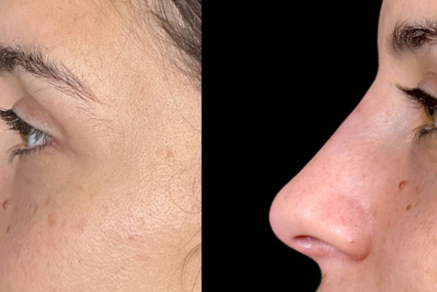 Non Surgical Nose Job Miami 17