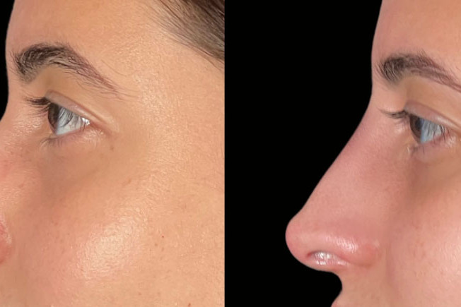 Non Surgical Nose Job Miami 18