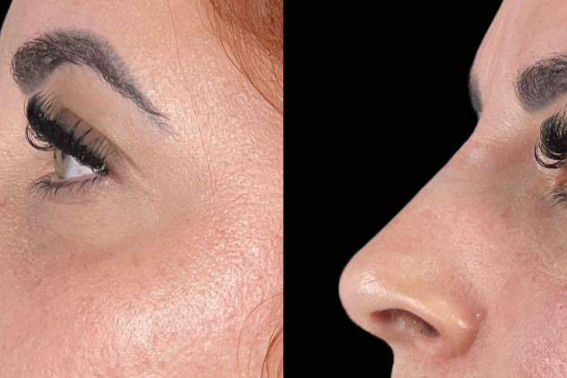 Non Surgical Nose Job Miami 20