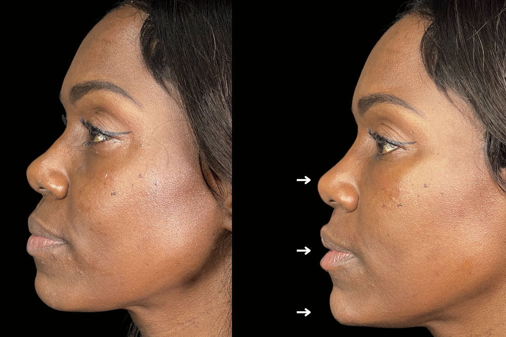 Non Surgical Nose Job Miami 23