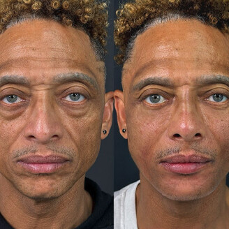 Facial Balancing west palm beach