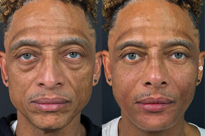 Facial Balancing west palm beach