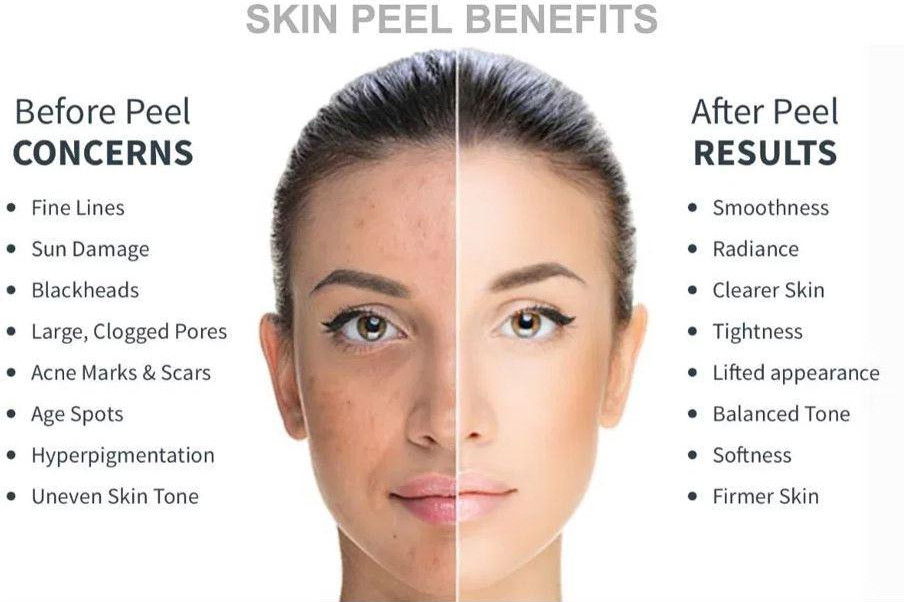 chemical peel benefits uai
