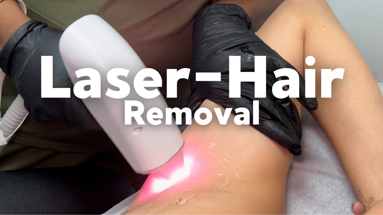 laser hair removal